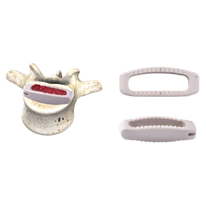 Minimally Invasive Small - Incision Anterolateral Lumbar Interbody Fusion System