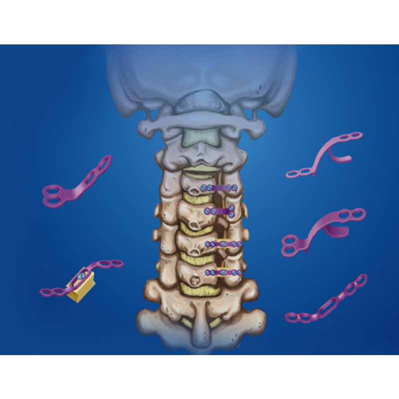 MAINSTAY Posterior Cervical Laminoplasty Internal Fixation System Laminoplasty Solution