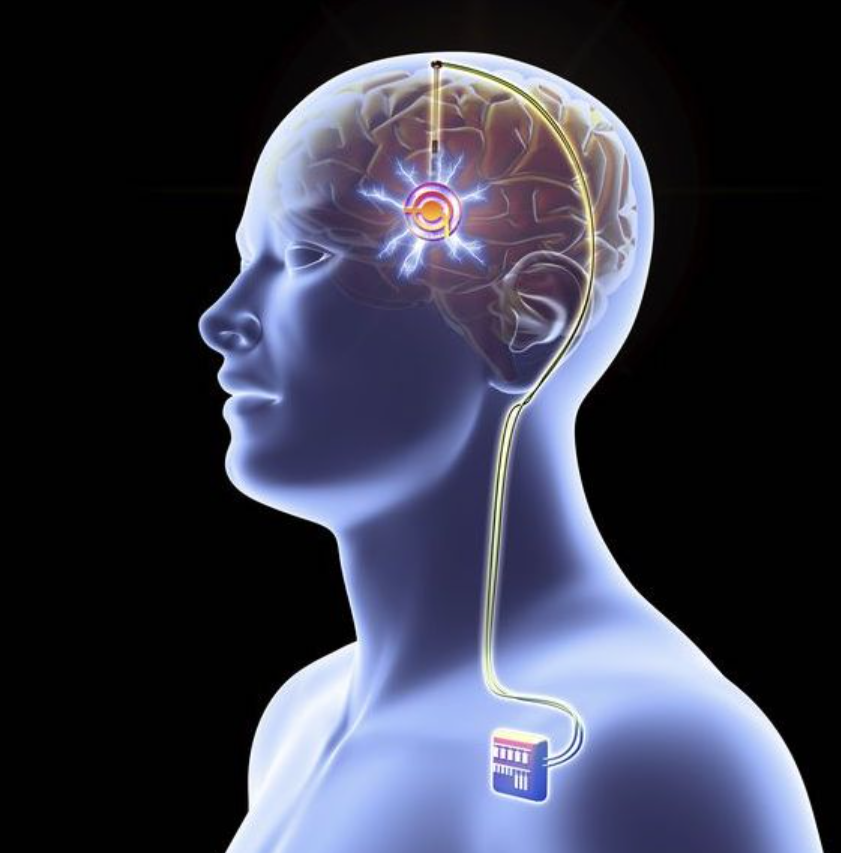 Neuromodulation & BCI+DBS